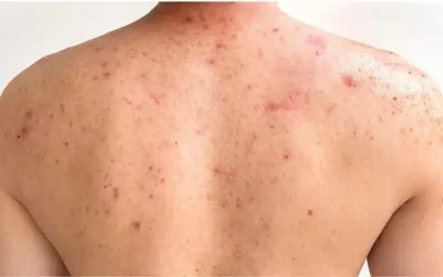 Back Acne Treatment – How To Treat Back Acne?