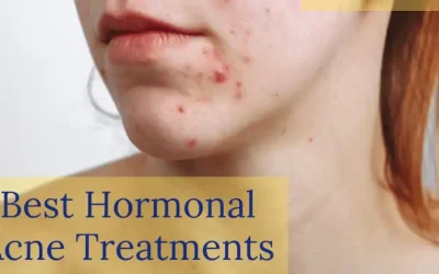 Best Hormonal Acne Treatment – How To Treat Hormonal Acne Naturally